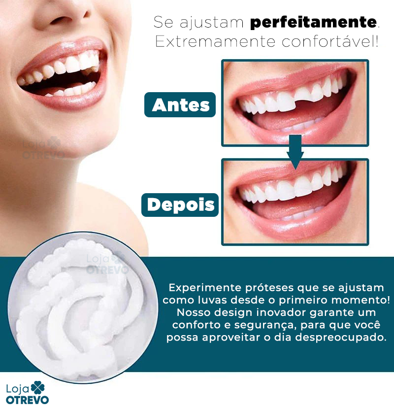 Nature Smile® - Facetas Dentárias Removíveis